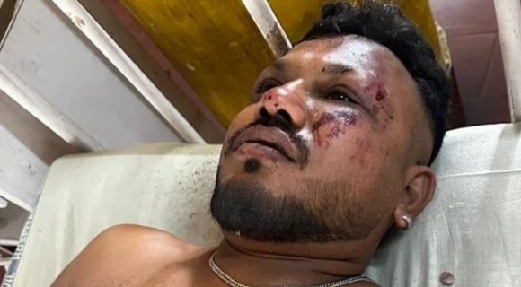 242명을 태운 에어인디아 여객기가 12일(현지시간) 인도 서부 구자라트주 아메다바드 공항에서 이륙한 직후 추락했다. 사진은 승객 242명 중 유일한 생존자로 추정되는 인도계 영국인 라메쉬가 병원에서 치료를 받는 모